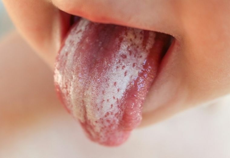 Dlaczego w jamie ustnej występują białe plamy na śluzówce