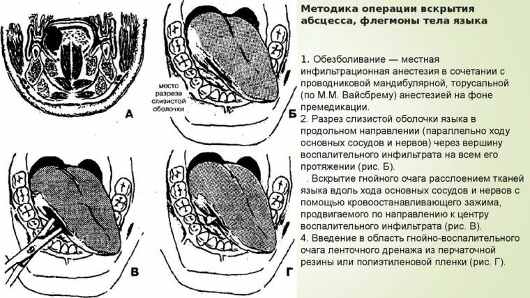 Abcès de la langue - processus inflammatoire avec formation d'abcès