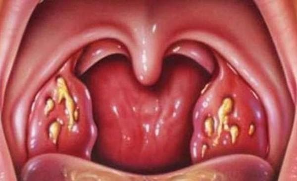follicular sore throat