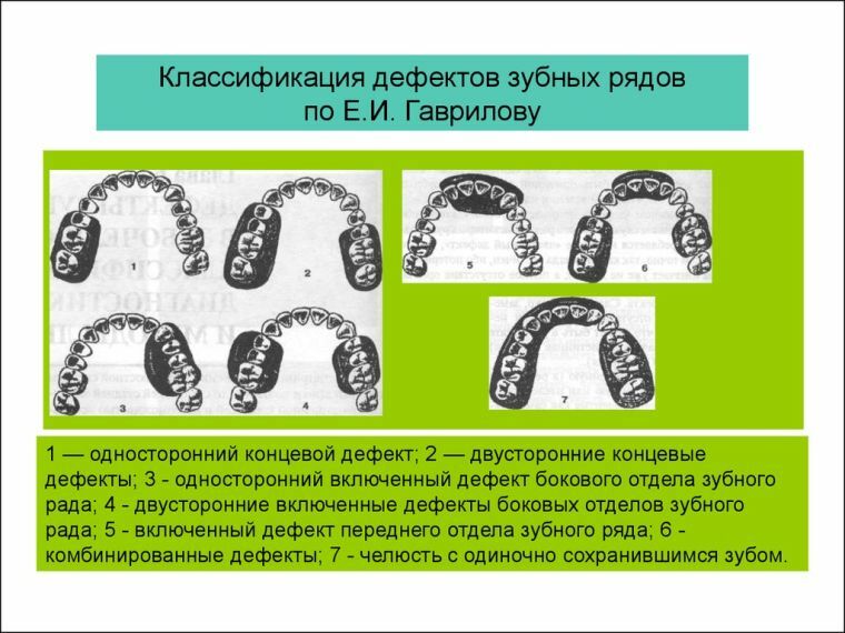 Mangler i tandprotesen og deres klassificering ifølge forskellige forfattere