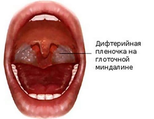 mal di gola fibrosante