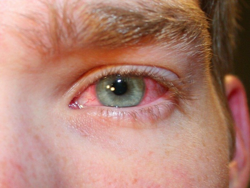 Les yeux rouges chez les adultes et les enfants: causes, traitement. L'œil rouge fait mal et démange: que faire, comment enlever les vaisseaux sanguins rouges dans les yeux?