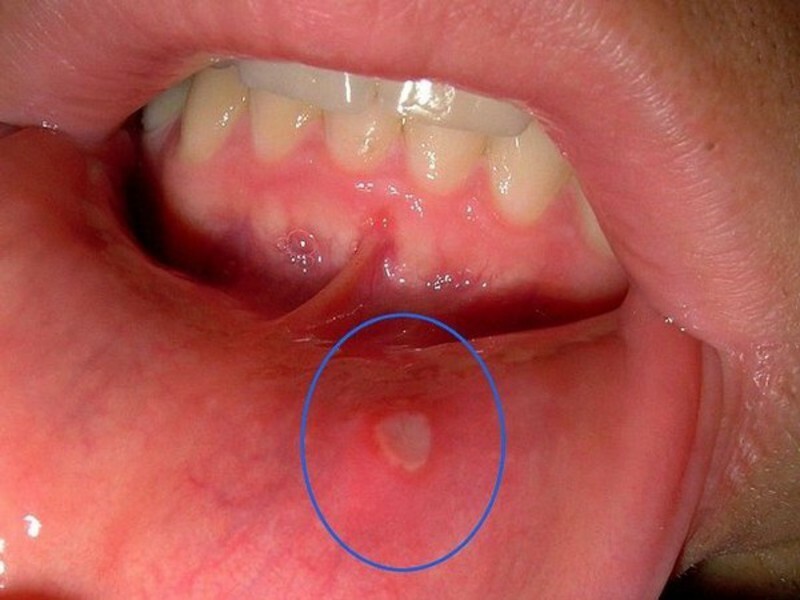 Gorivo u ustima i na jeziku: što uzrokuje bolest? Lit jezik: uzroci i liječenje