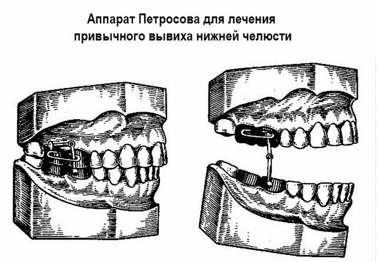 Como identificar a deslocação do maxilar - tratamento corretivo e operatório da articulação