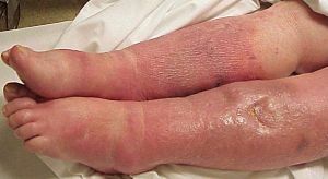 Periflebit - what to do if the tissues surrounding the veins become inflamed
