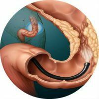 Kaj je irigoscopy( kontrastiranje) črevesja