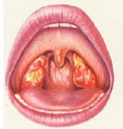 ulcerative-membranous angina