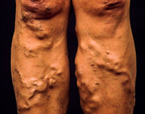 Farorna med flebit i nedre extremiteterna - bilder av patologi och metoder för behandling