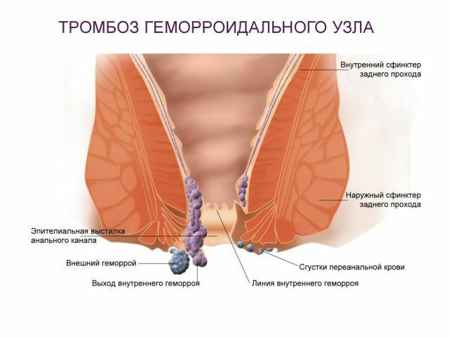 trombose av hemorroider