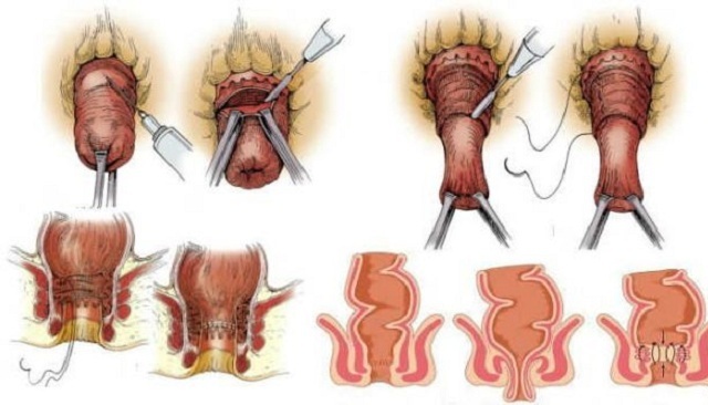 Operation with prolapse of rectum