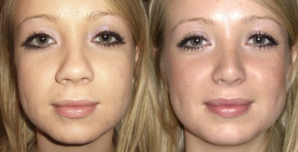 Rhinoplasty of the nose - types, indications, contraindications and photos