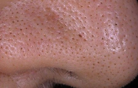 ¿Qué son los comedones, sus tipos y por qué aparecen en la cara y otras partes del cuerpo?