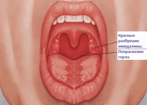 tonsillite acuta catarrale