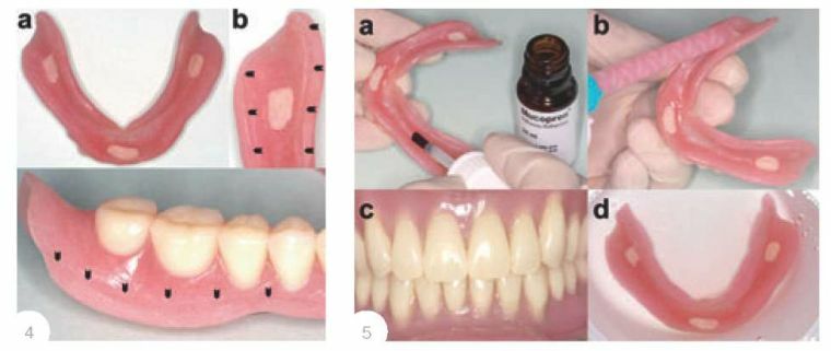 Zu welchem ​​Zweck und wie genau erfolgt die Verlagerung von herausnehmbarem Zahnersatz