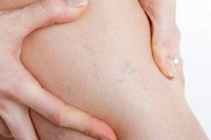 Što je opasno varikozno dermatitis i kako ga izliječiti