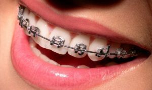 Kui palju maksab hambaproteeside paigaldamine?