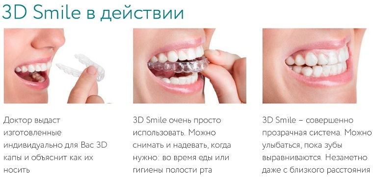 Shining smile without brackets with an unrivaled 3D Smile system