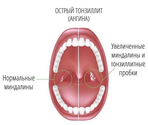 inflammation of the tonsils on one side