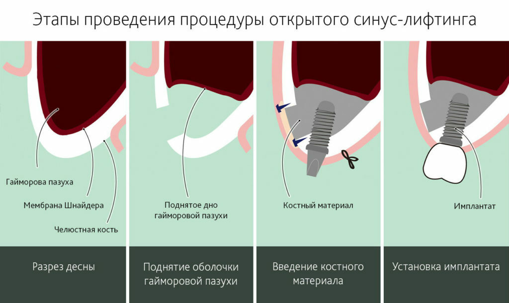 Kenmerken van de installatie van implantaten op kauwtanden