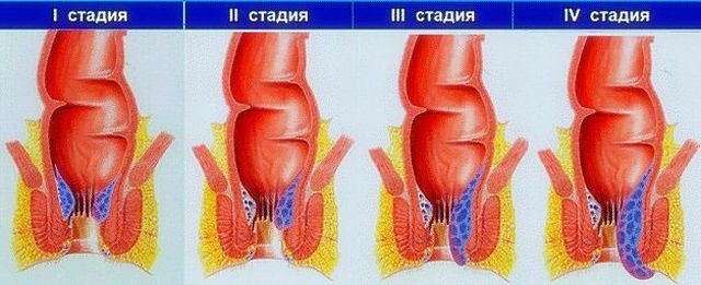 Stages of hemorrhoids