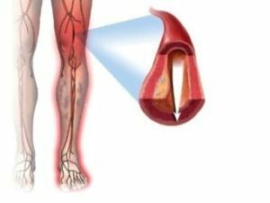 Symptoms and treatment of lower limb vessels