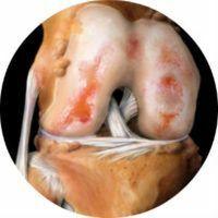 Causes, symptômes et traitement de l'arthrose du genou