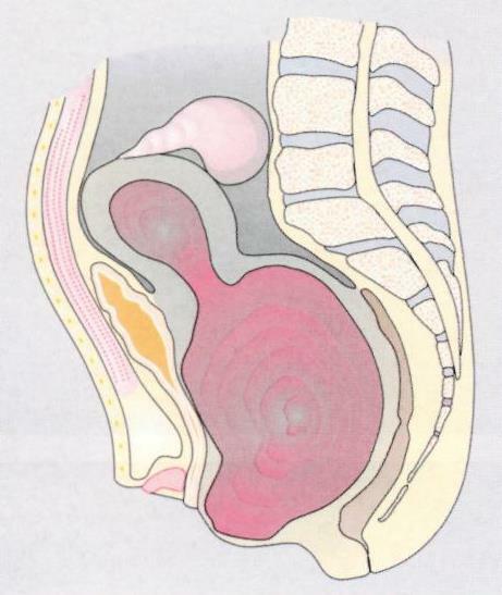 Atresia vaginal: terço inferior, sintomas, tratamento
