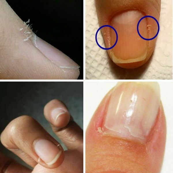 Causes de bavures sur les doigts et un traitement correct