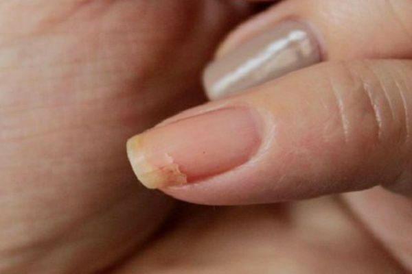 Årsager og metoder til bekæmpelse af sprængning af negle i hænderne