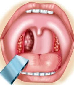 swelling in the throat