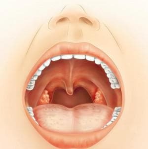 herpes sore throat