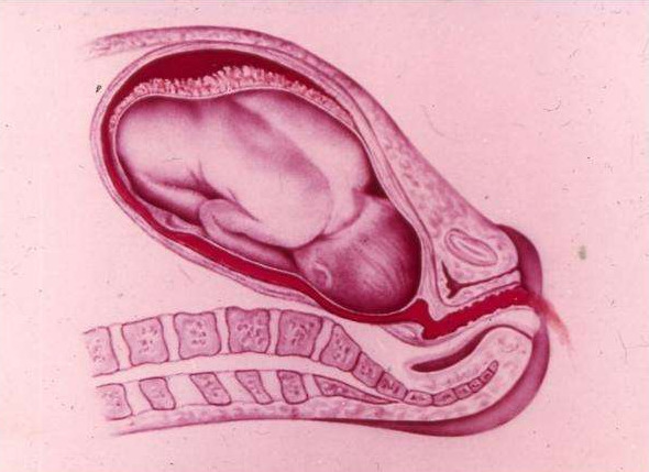 Voortijdige placenta-abruptie: oorzaken, symptomen, behandeling