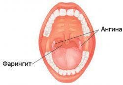 inflammation of the tonsils in the throat of children