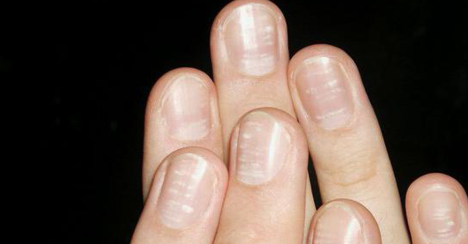 Why do white nails appear on the nails of the hands and feet? What do white strips on the nails mean?