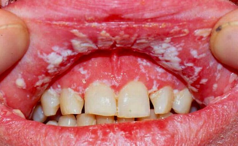 Catarrhal stomatitis er en almindelig og meget ubehagelig sygdom