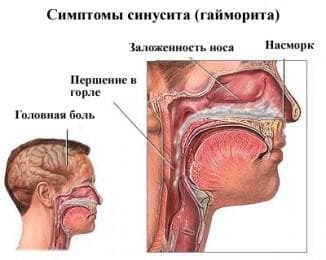 סינוסיטיס של האף