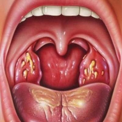 what does sore throat look like in adults