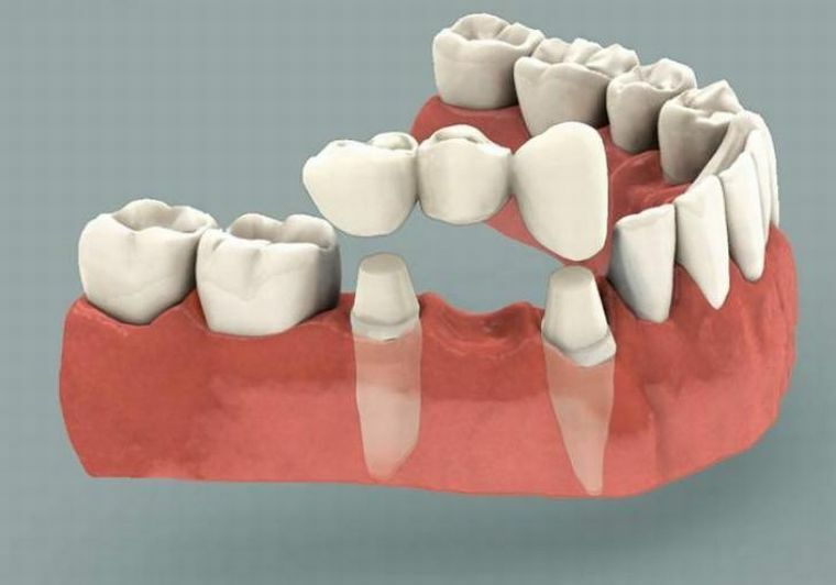 Pevné zubní protézy: odrůdy a vlastnosti