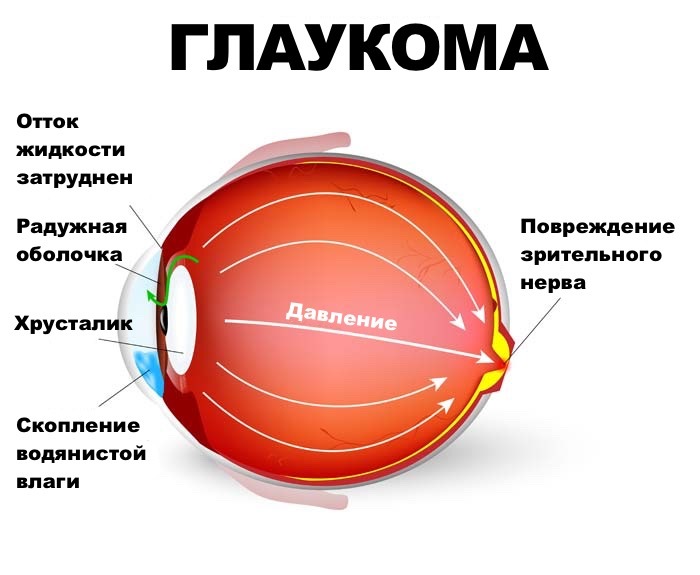 Doutrot - silmätipat silmänsisäisen paineen vähentämiseksi