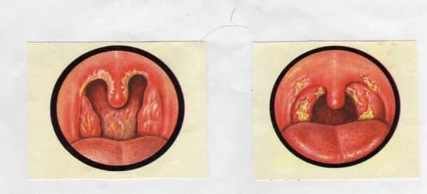 tonsillite follicolare