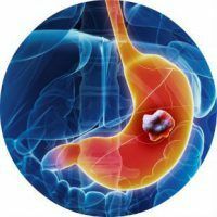 Znaki in simptomi raka želodca in kako ga zdraviti
