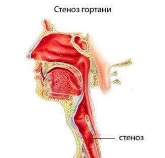 stenosi della laringe nei bambini