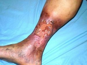 As a result of which postthrombotic disease develops