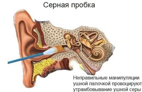 simptomi i liječenje ušnih utikača
