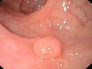 polyp in the rectum