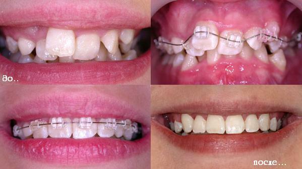 Alles über Zahnspange: Installation, Entfernung, wie viel zu tragen