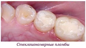 Cosa può e non può essere fatto dopo il riempimento dei denti