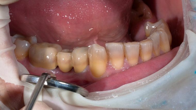 Dentes transparentes: quando é a norma, e quando o tratamento é necessário?