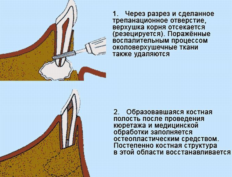 Цистоэктомия. Техника проведения операции резекции верхушки корня.. Методика проведения операции резекции верхушки корня зуба. Резекция верхушки корня этапы операции. Резекция верхушки корня 1 зуба это.