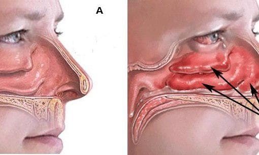 vasomotorische rhinitis bij een volwassene